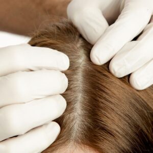 Mesoterapia Capilar
